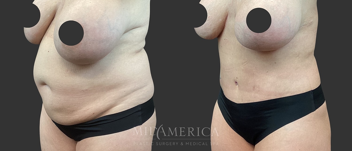 Tummy Tuck Before & After