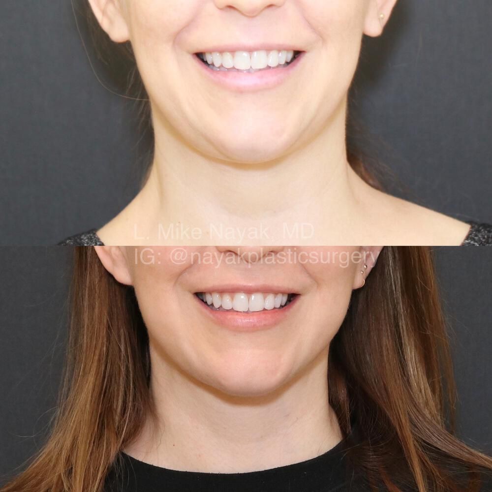 Facelift And Neck Lift Before & After