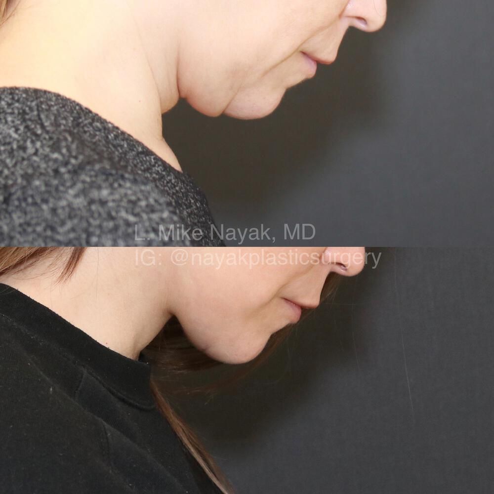 Facelift And Neck Lift Before & After