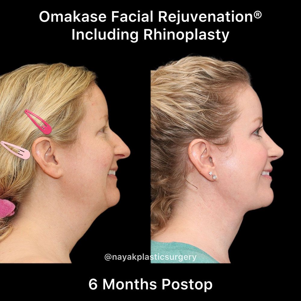 Facelift And Neck Lift Before & After
