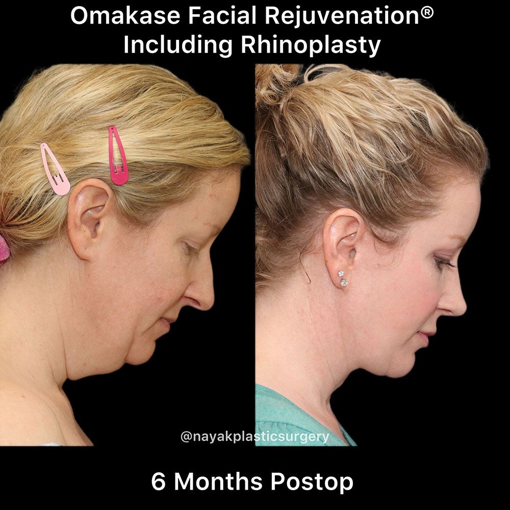 Facelift And Neck Lift Before & After