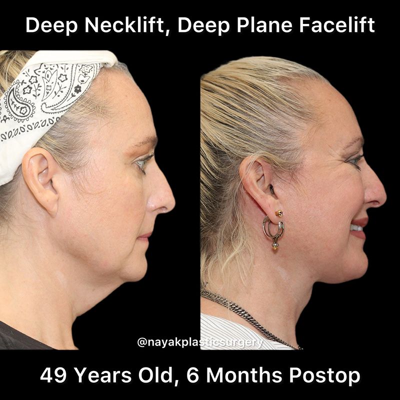 Facelift And Neck Lift Before & After