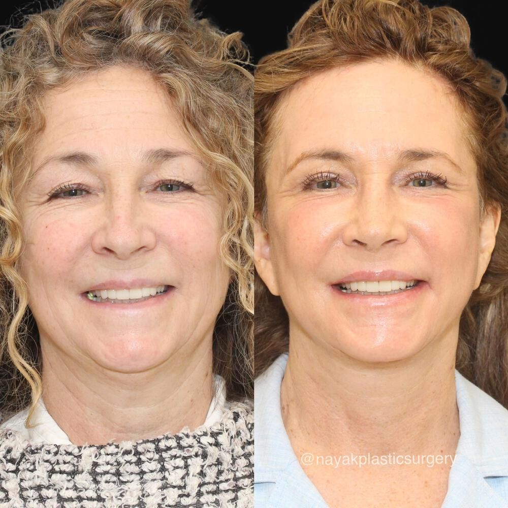 Brow Lift Before & After