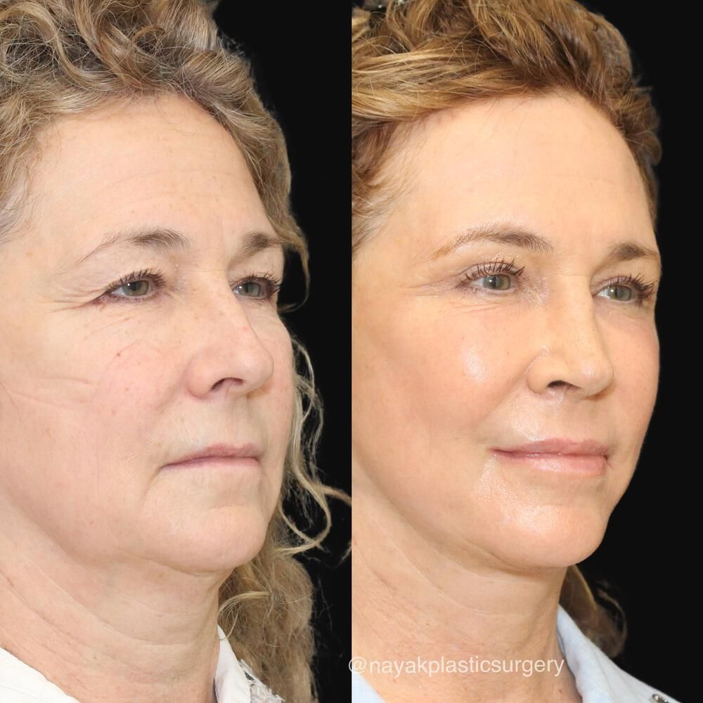 Brow Lift Before & After