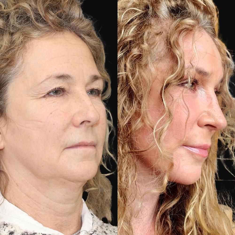 Brow Lift Before & After