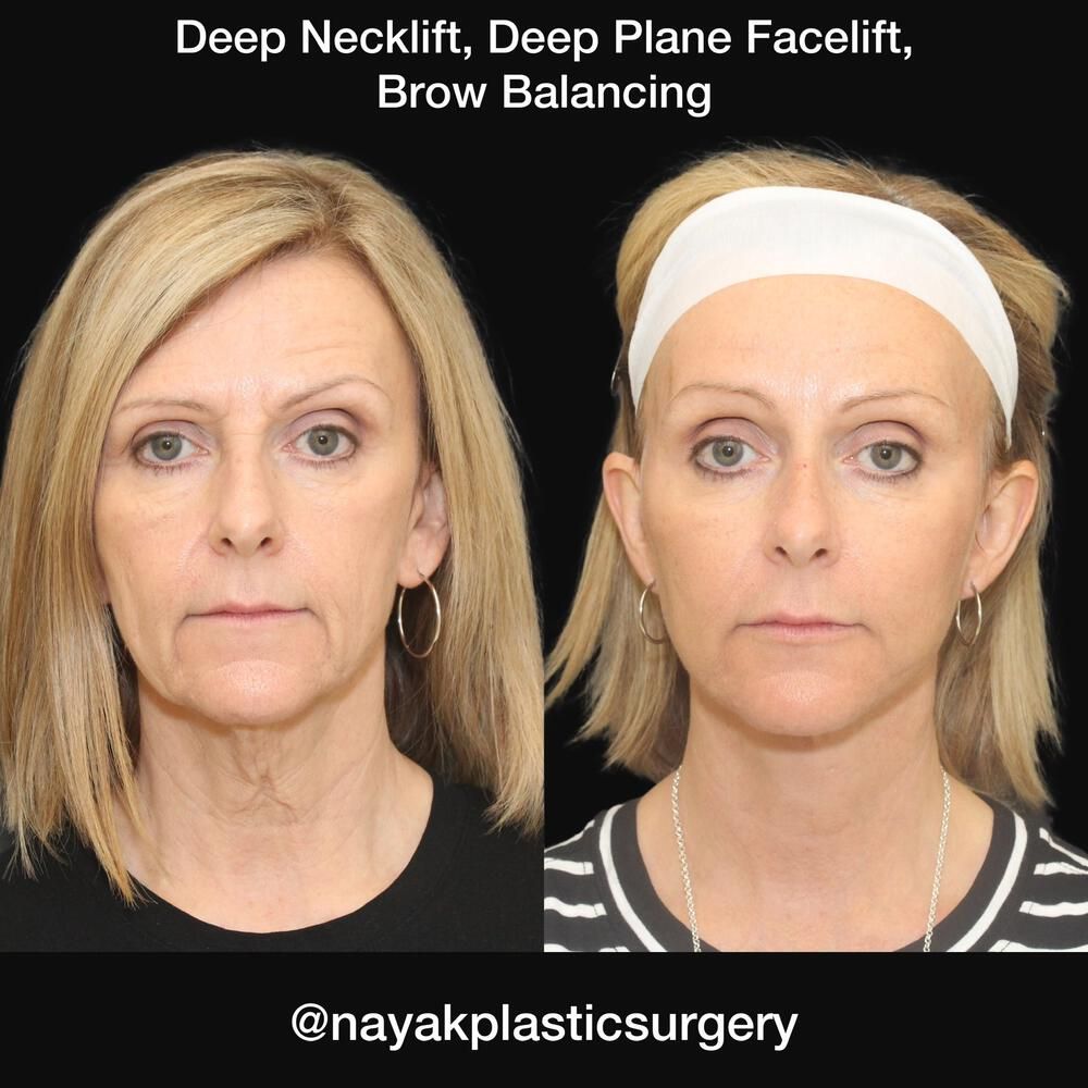 Brow Lift Before & After