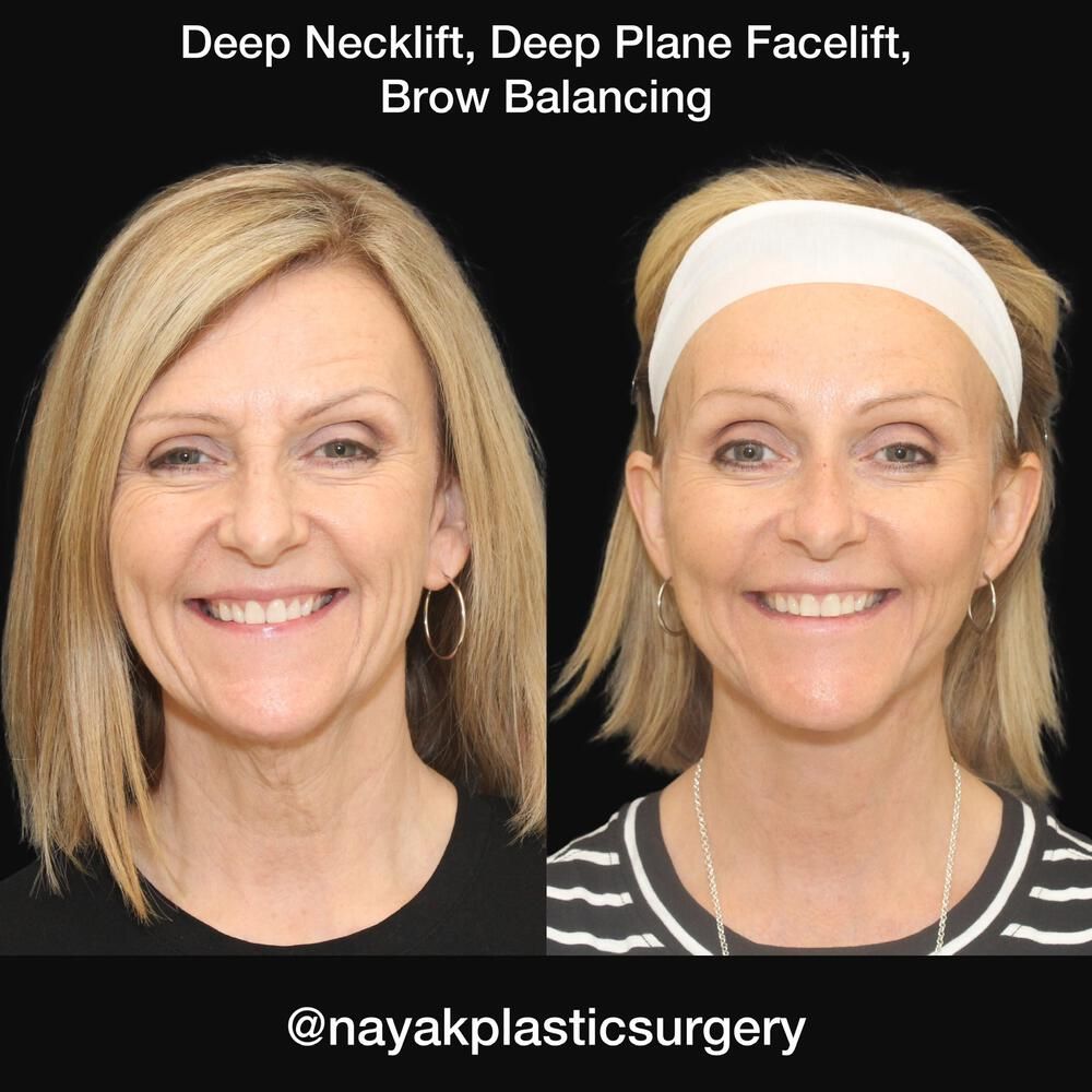 Brow Lift Before & After