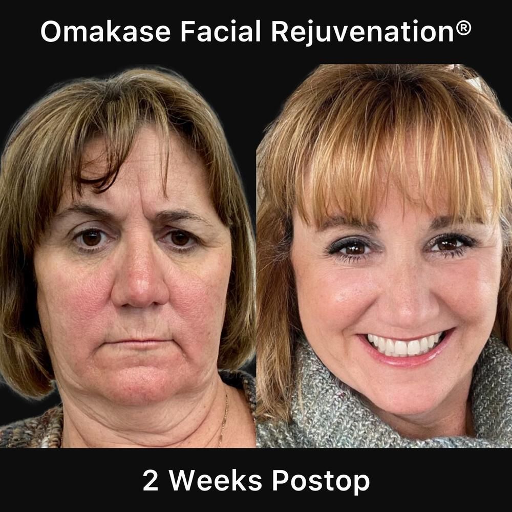 Brow Lift Before & After