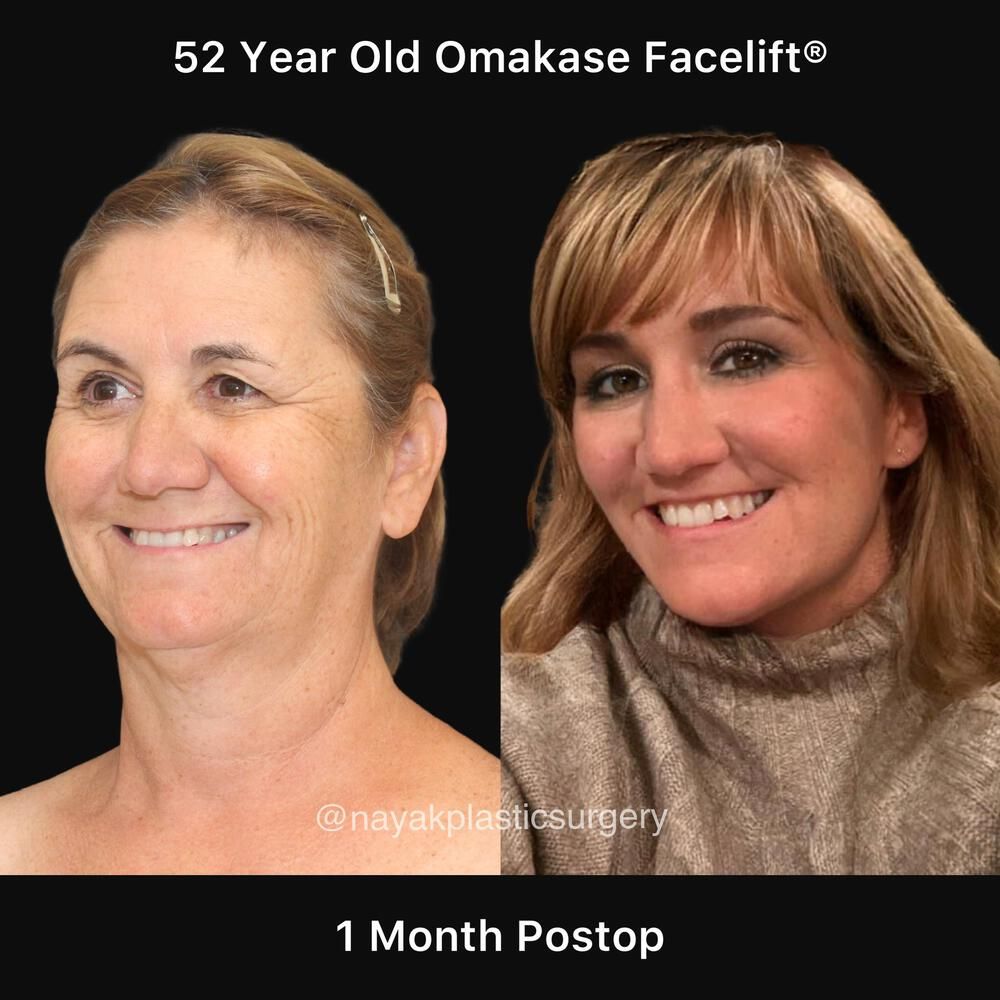 Brow Lift Before & After