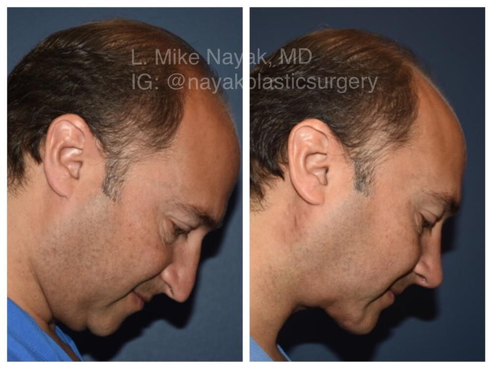 Deep Necklift Before & After
