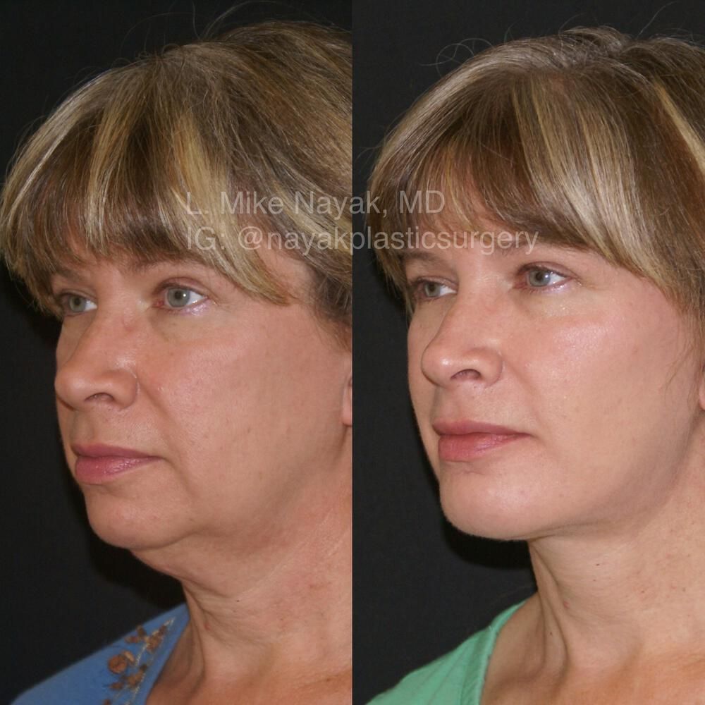 Chin Implant Before & After