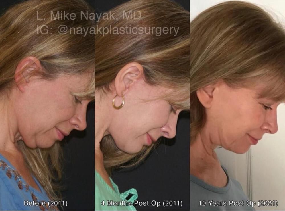 Chin Implant Before & After