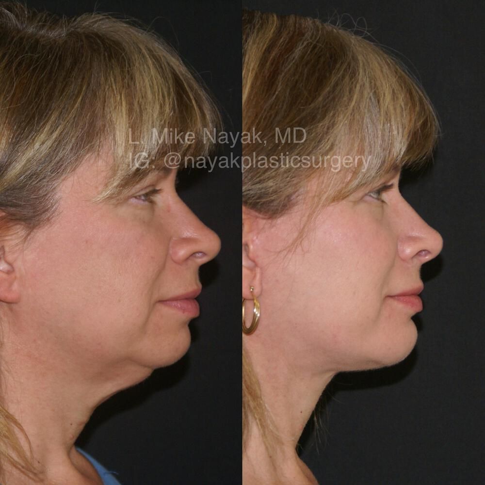 Chin Implant Before & After