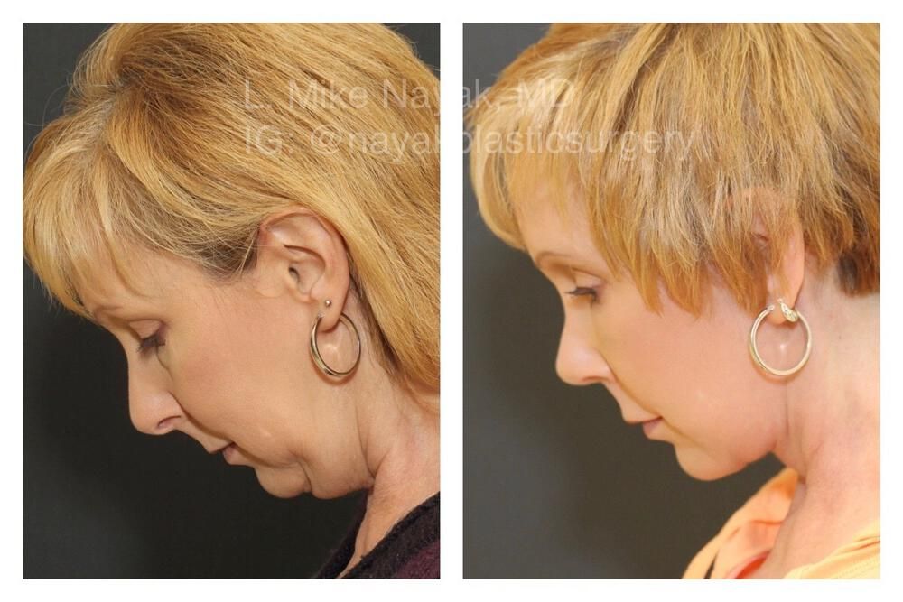 Rhinoplasty Before & After