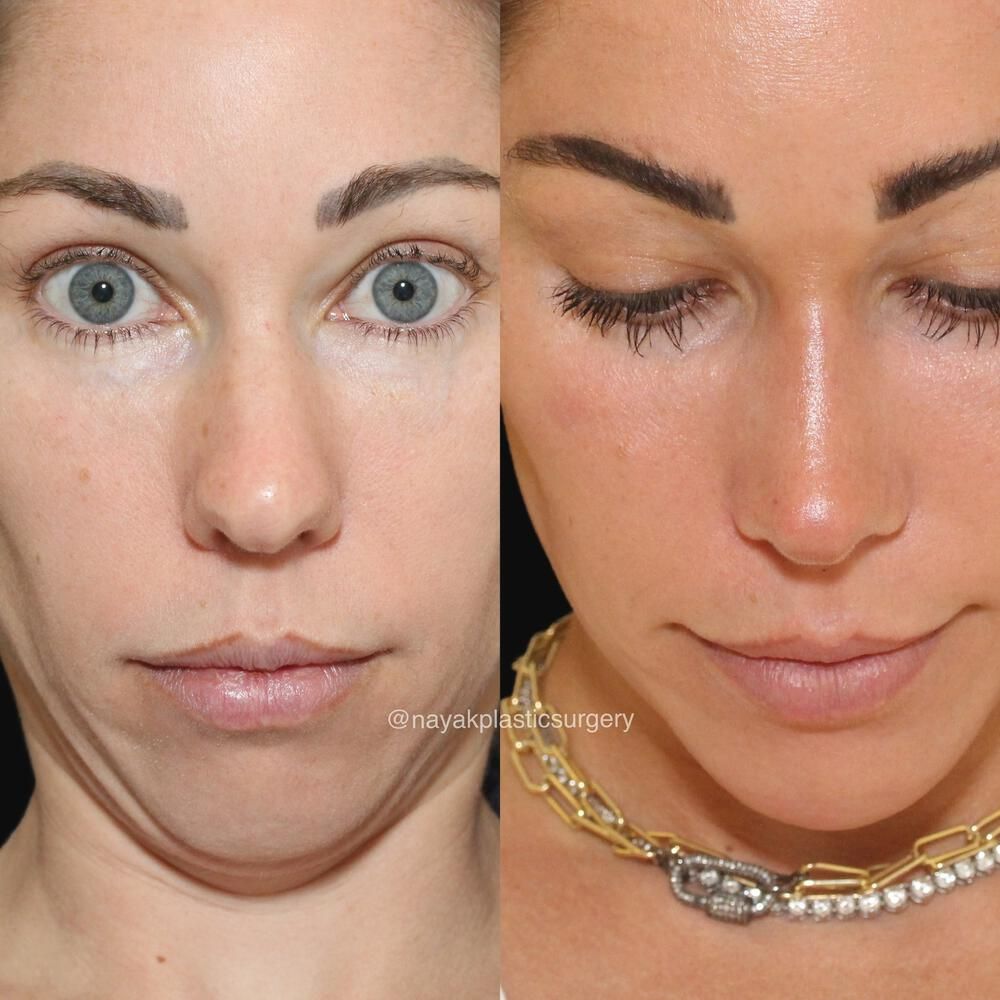 Rhinoplasty Before & After
