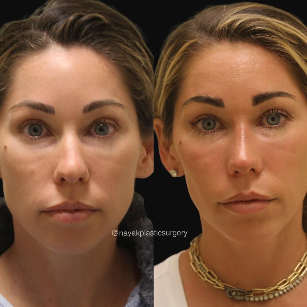 Rhinoplasty Before & After