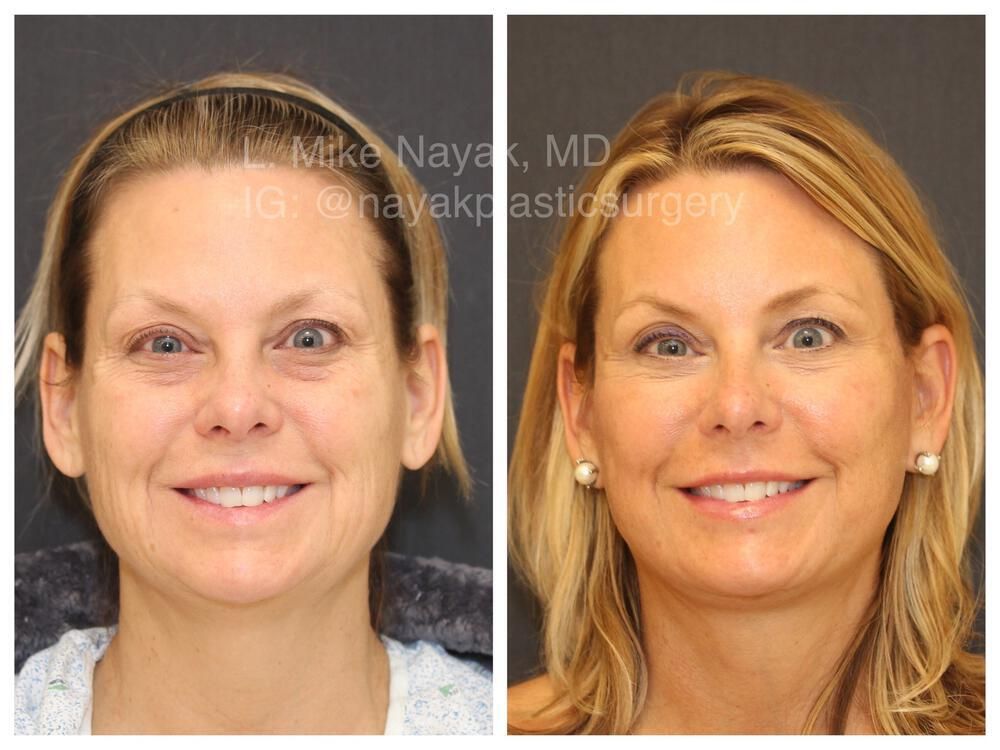 Blepharoplasty Before & After