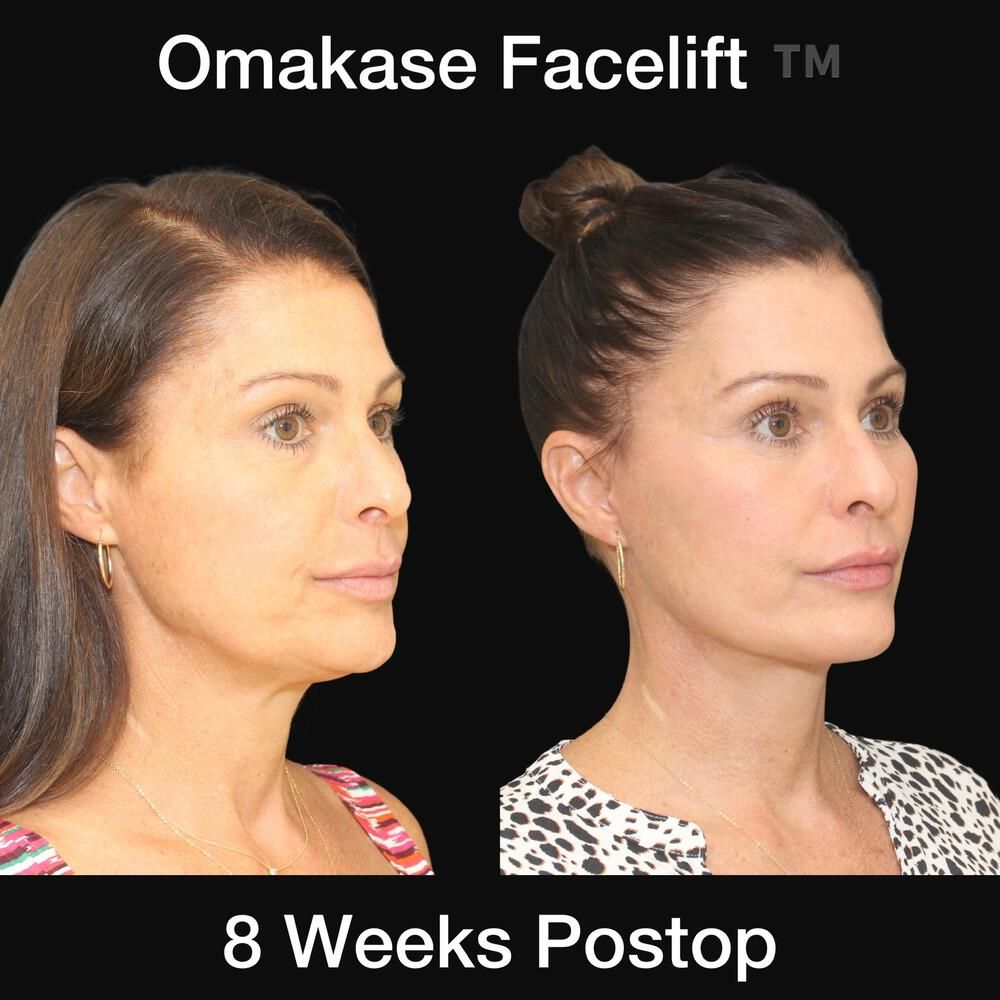 Blepharoplasty Before & After