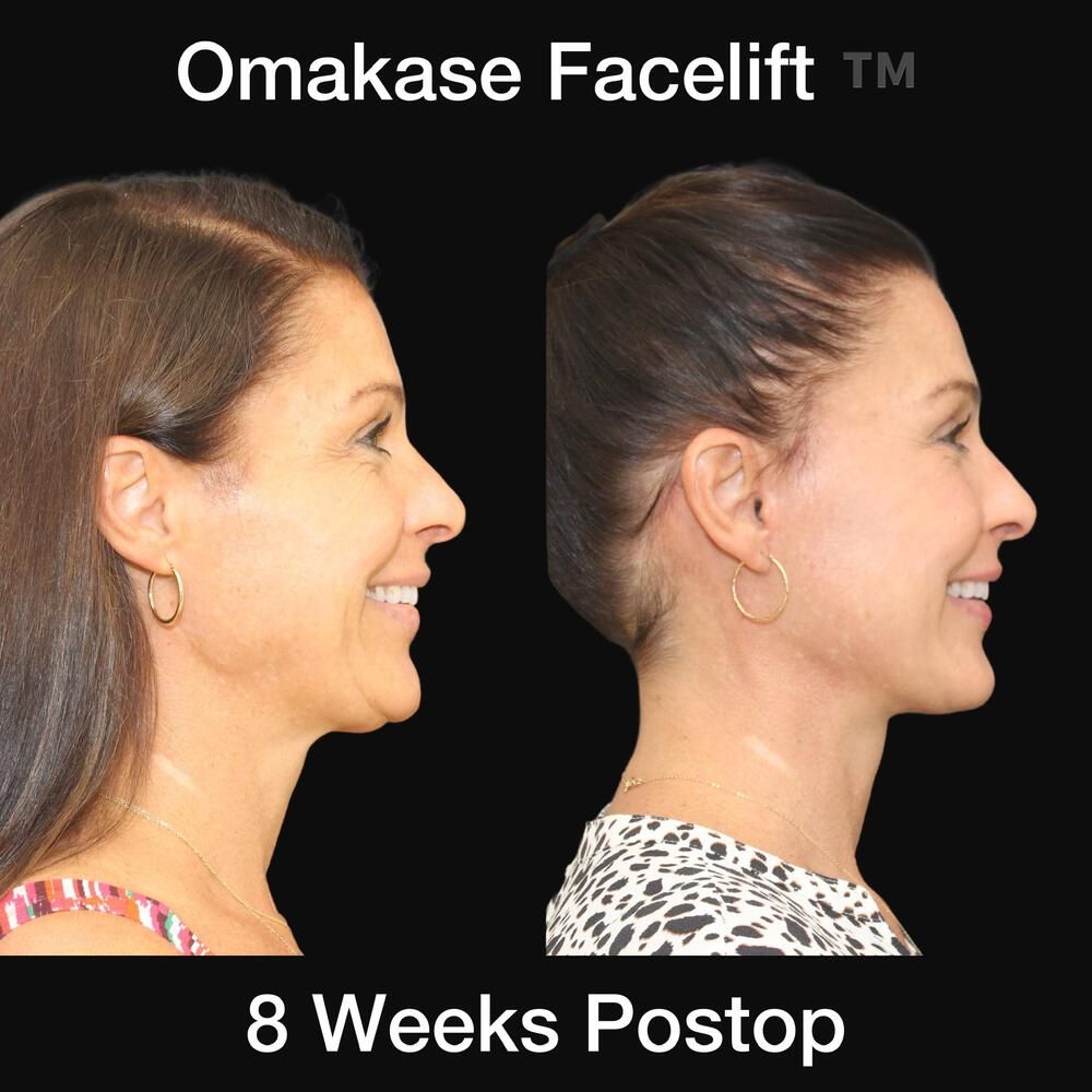 Blepharoplasty Before & After