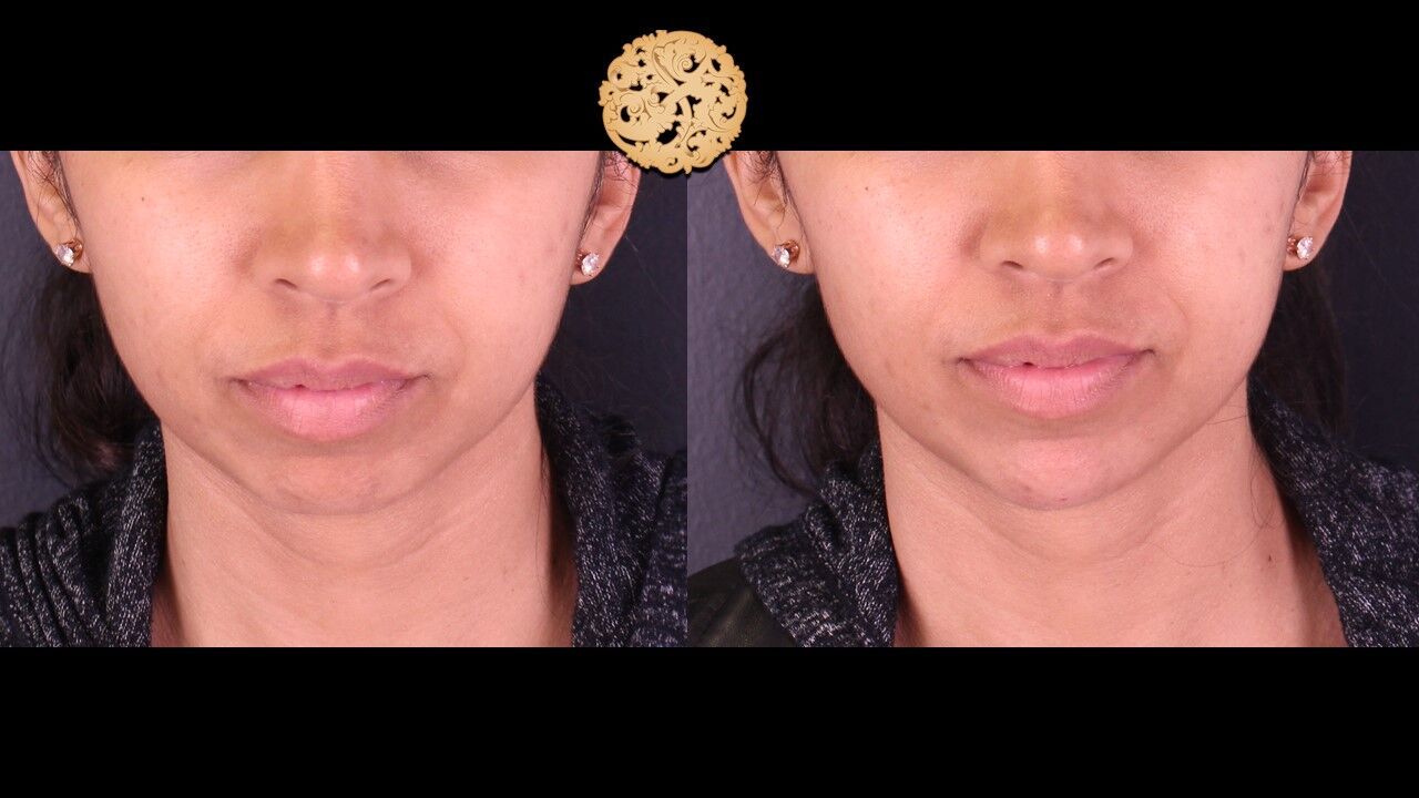  Before & After