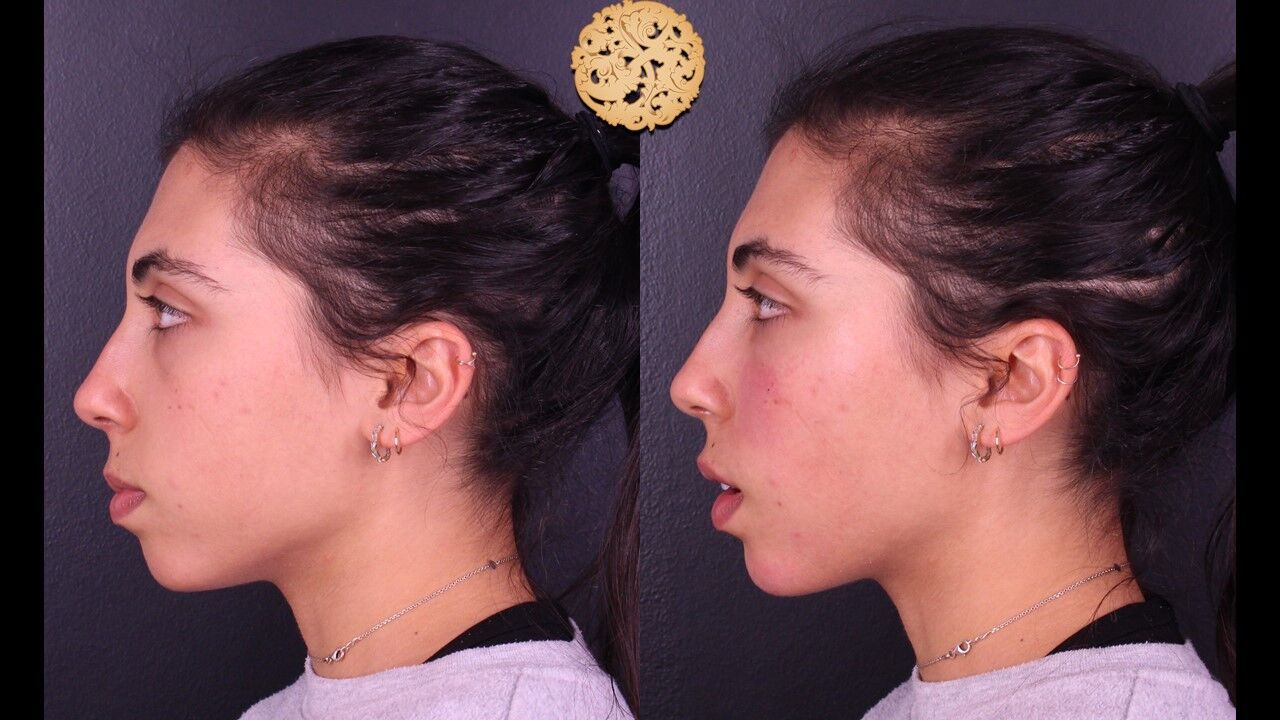  Before & After