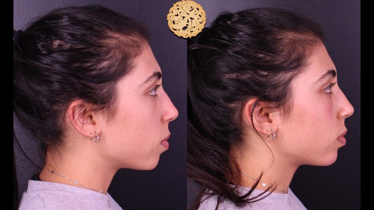  Before & After