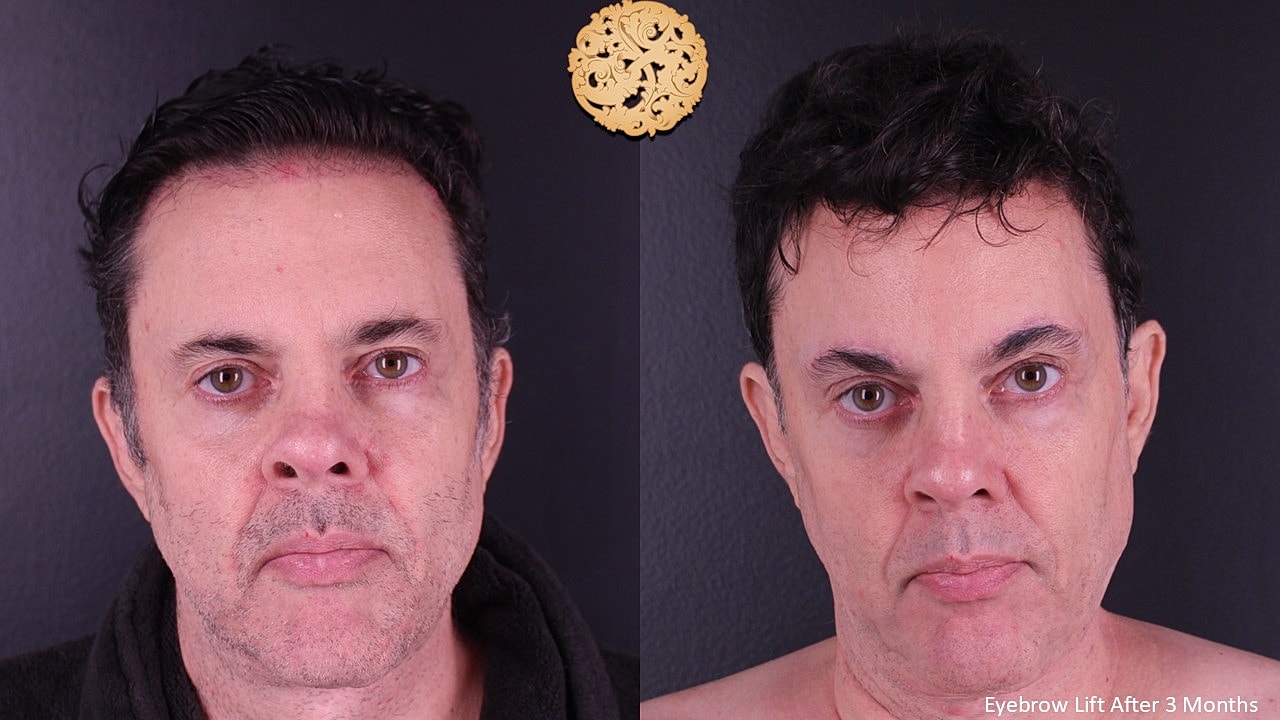 Brow Lift Before & After
