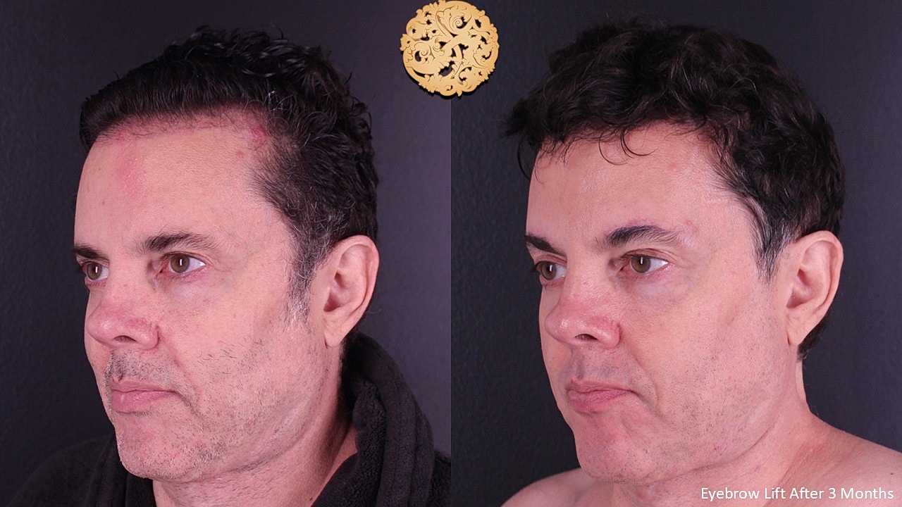 Brow Lift Before & After