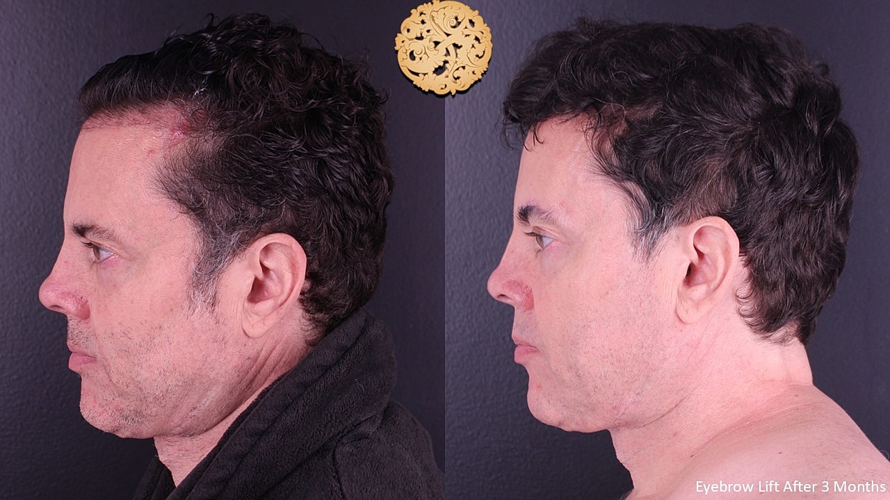 Brow Lift Before & After