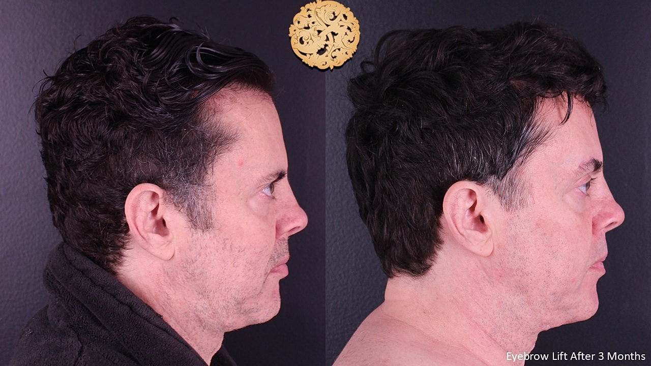 Brow Lift Before & After