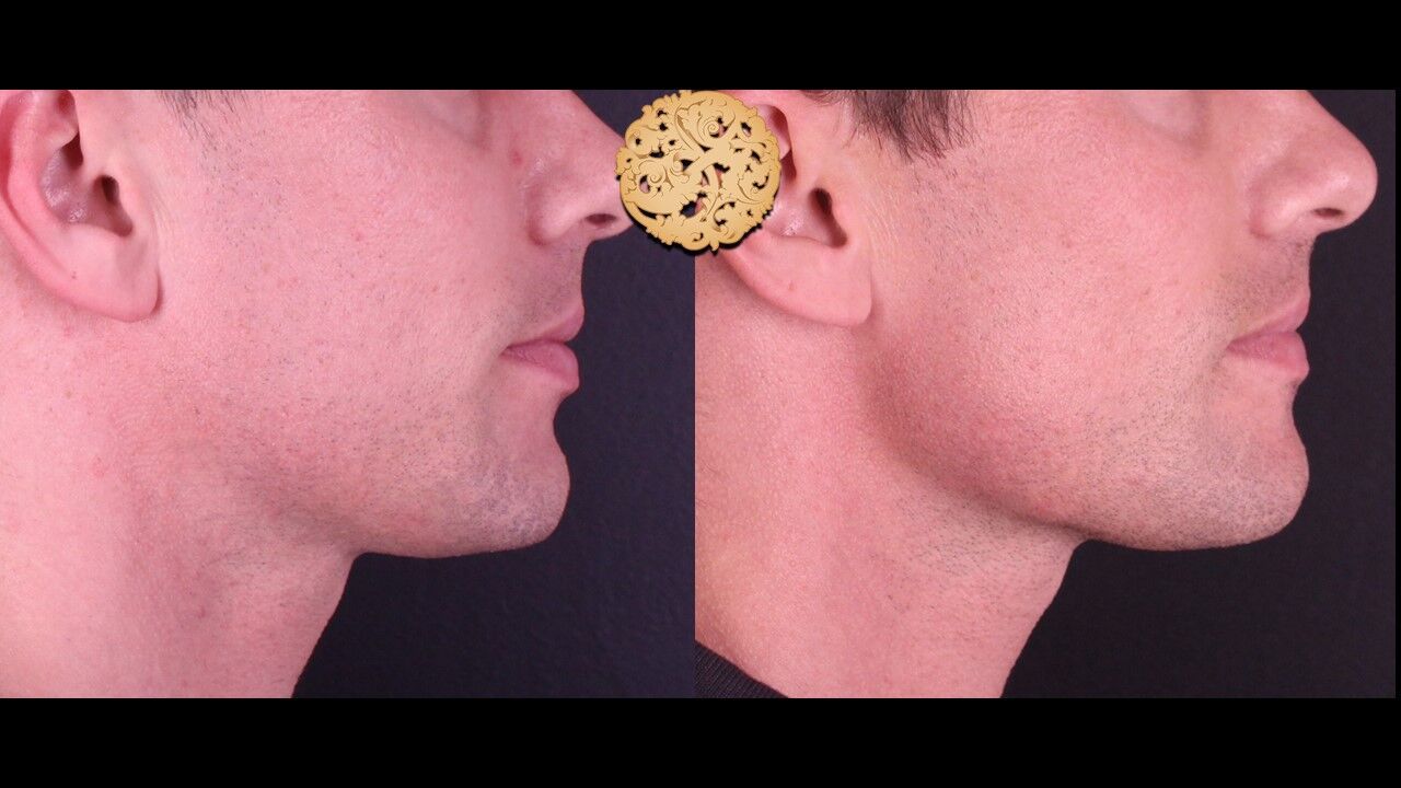 Jaw Filler Before & After