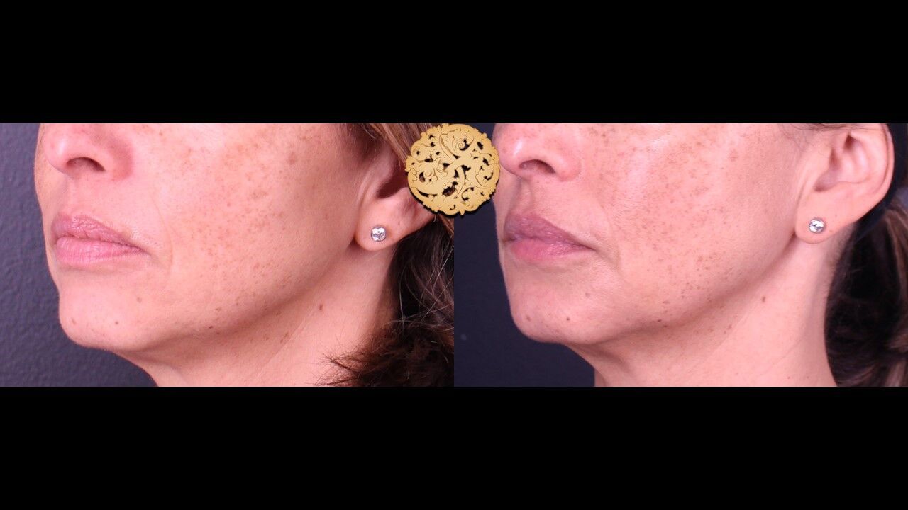 Lip Filler Before & After