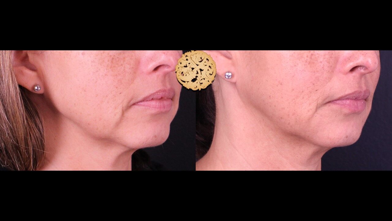 Lip Filler Before & After
