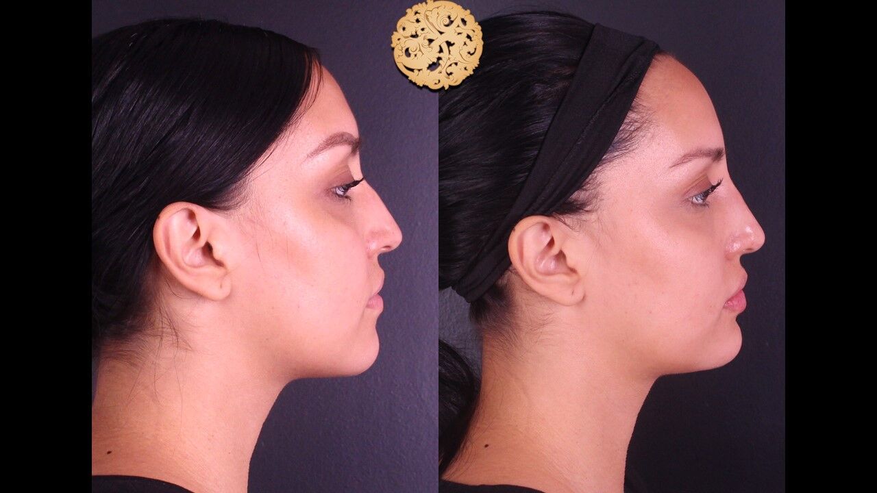 Lip Filler Before & After