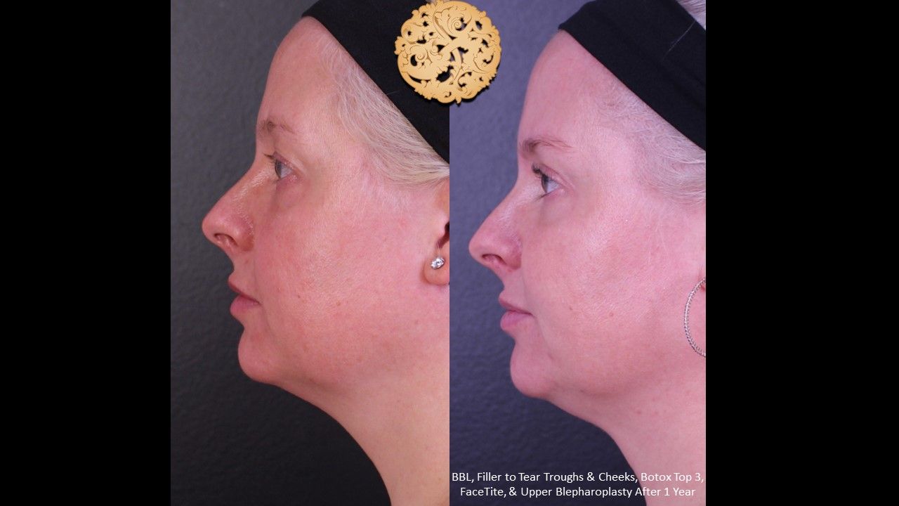Facetite Before & After