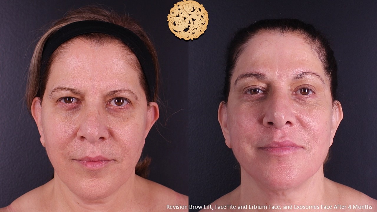 Facetite Before & After