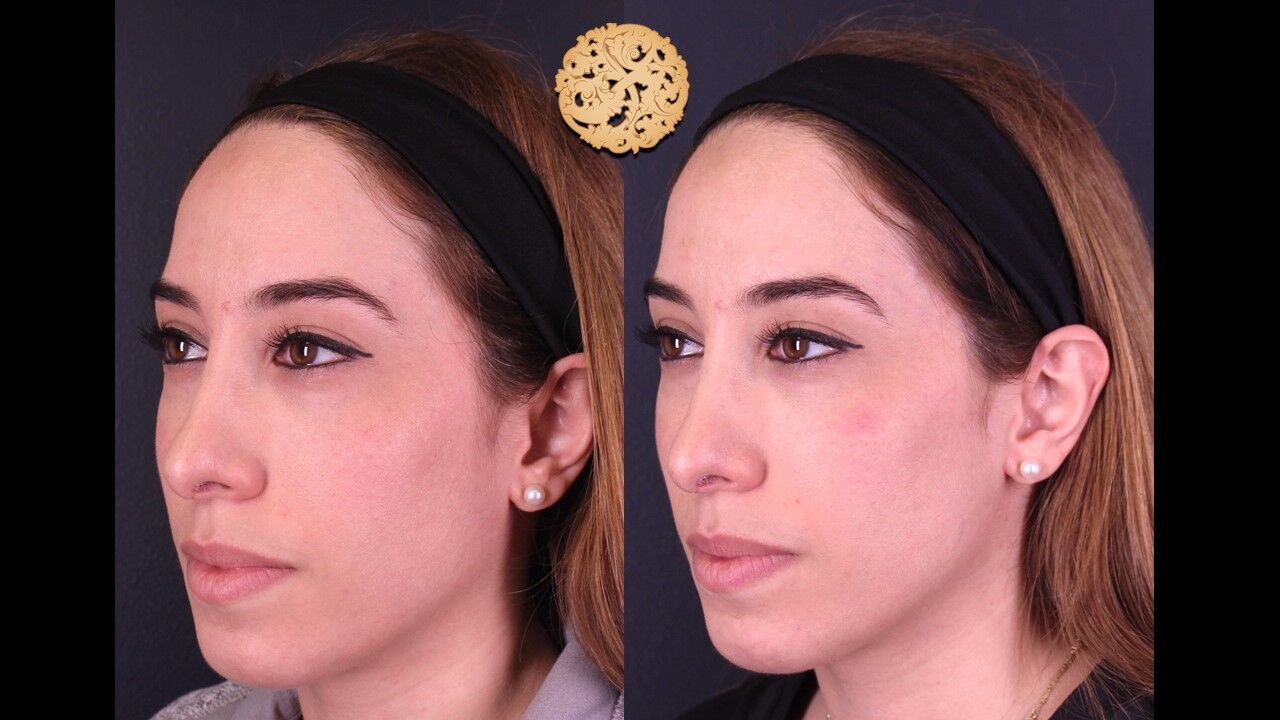 Cheek Filler Before & After