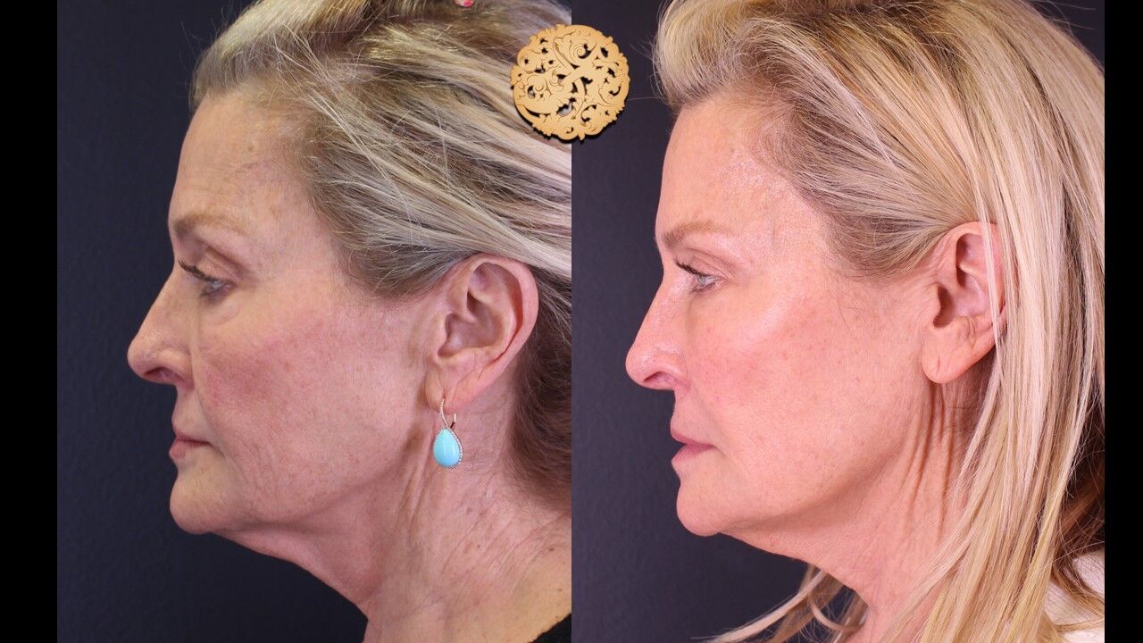 Cheek Filler Before & After