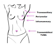 Breast augmentation graphic info