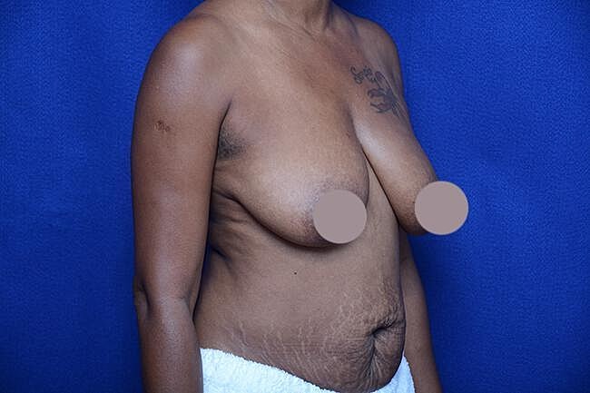 Breast Lift With Augmentation Before & After