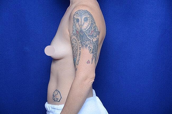 Breast Lift With Augmentation Before & After