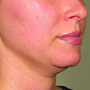 Ultherapy Before & After