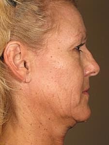 Ultherapy Before & After