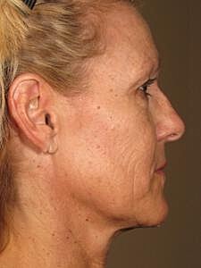 Ultherapy Before & After