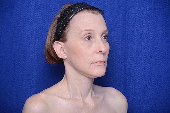 Brow Lift Before & After