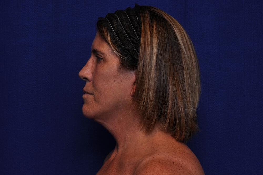 Brow Lift Before & After