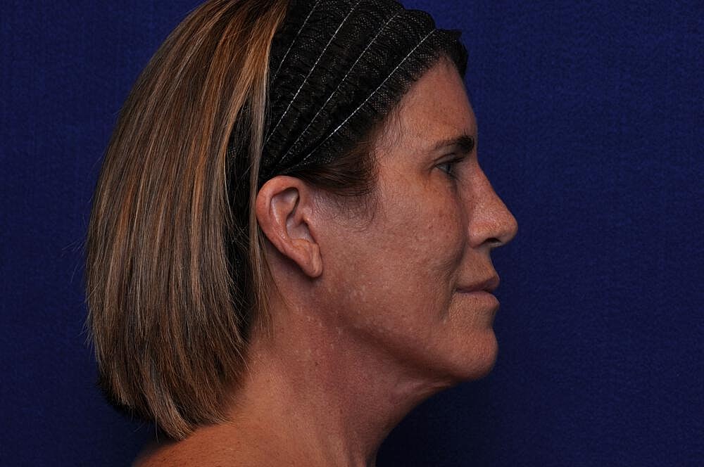 Brow Lift Before & After