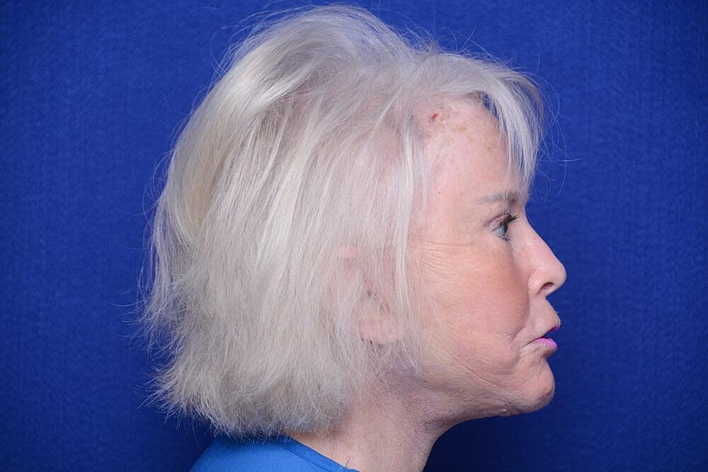 Brow Lift Before & After