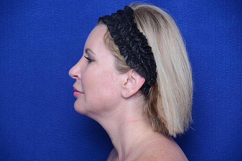 Chin Implant Before & After