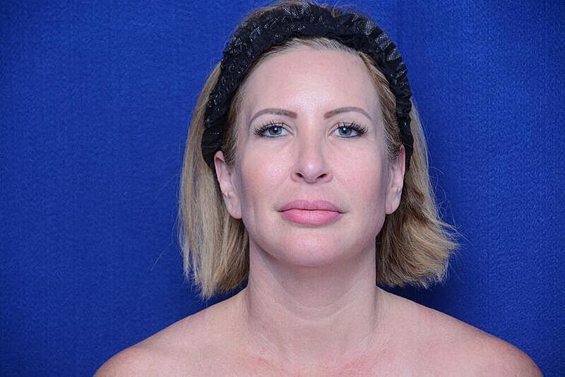 Chin Implant Before & After